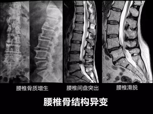 腰椎管狹窄是什麼鬼 頭條新聞